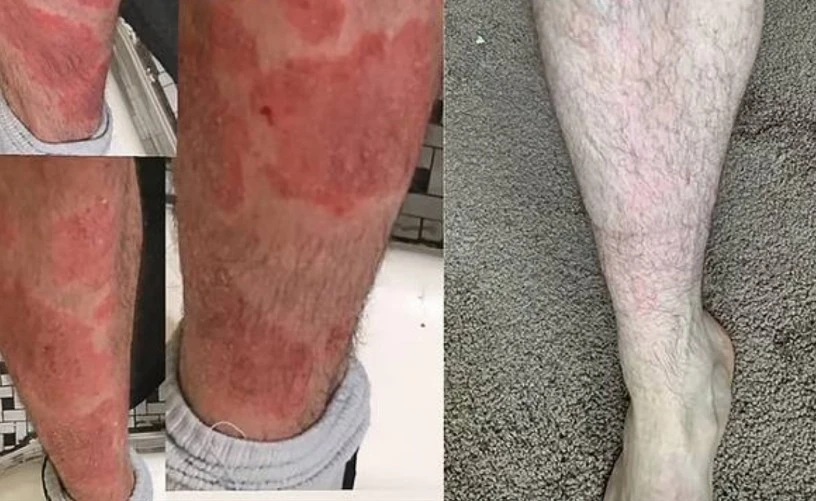Відгук покупця про Likoderm 3